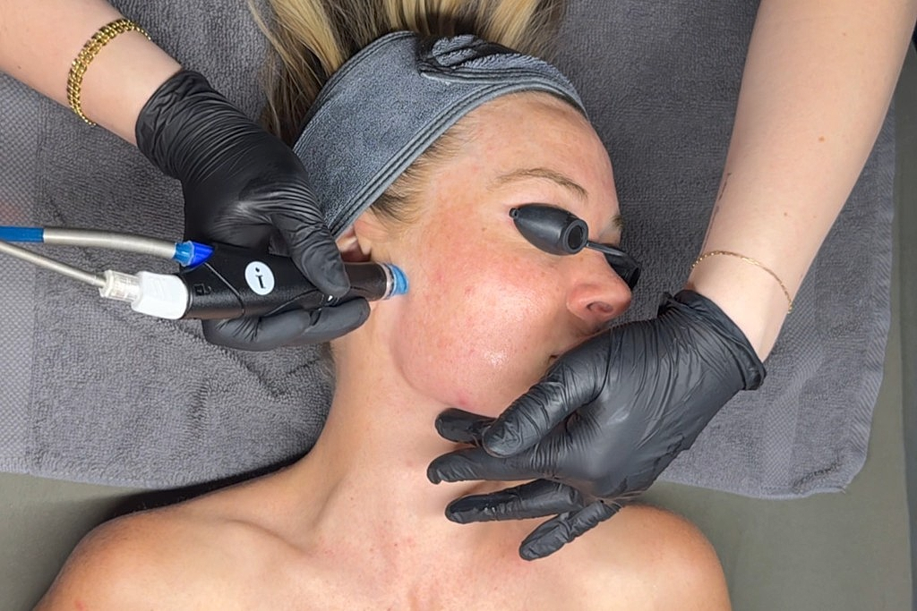 The Underrated Power of Hydrafacial
