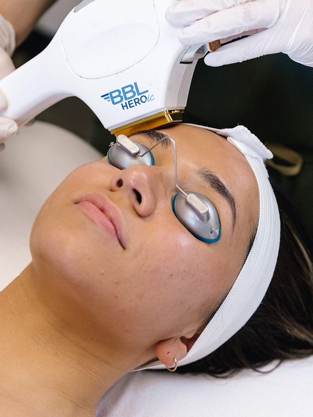 BBL treatment on a woman's face.