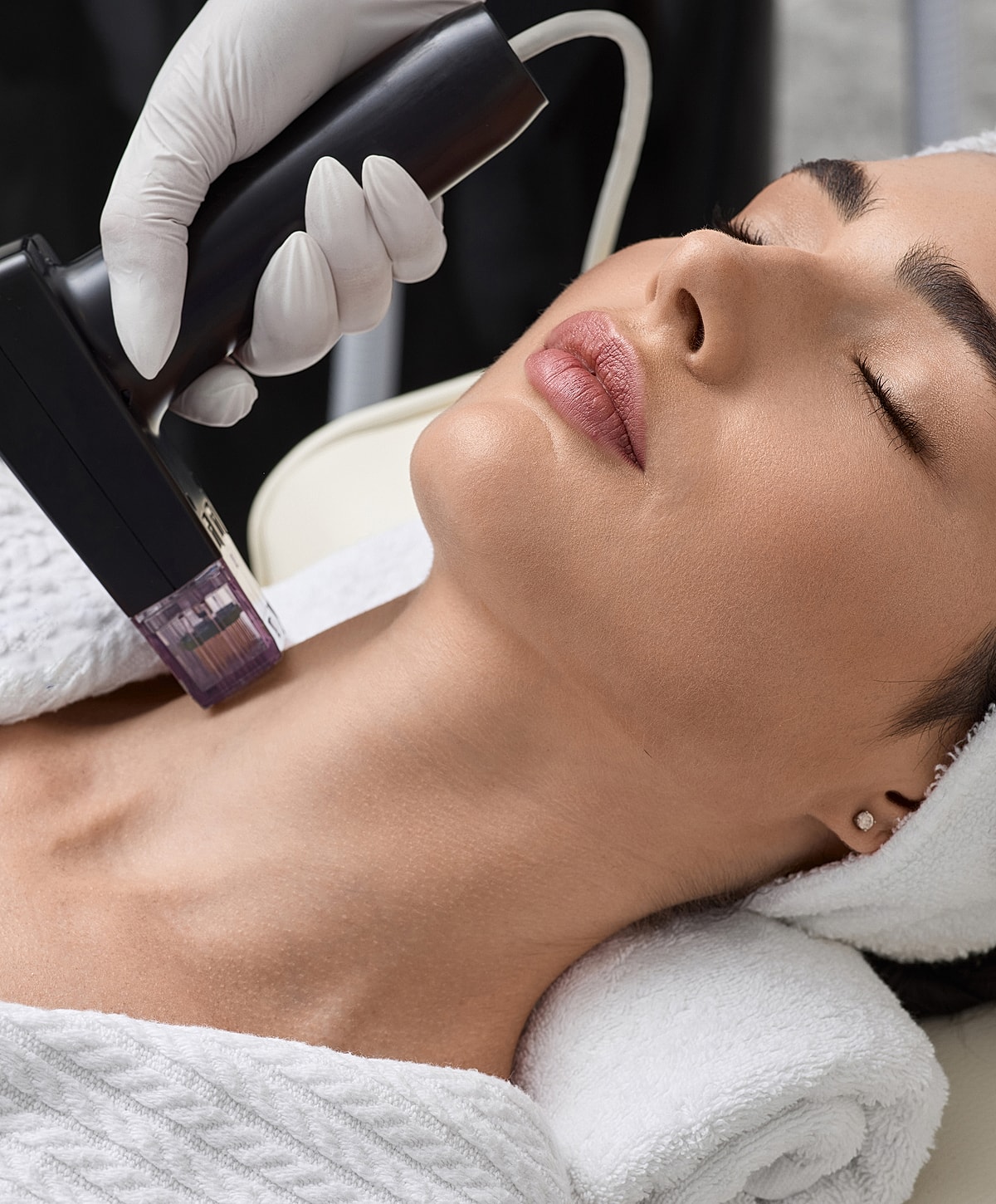 Facial treatment with a microneedling device.
