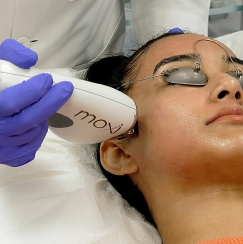 Skin treatment using a Moxi laser device.