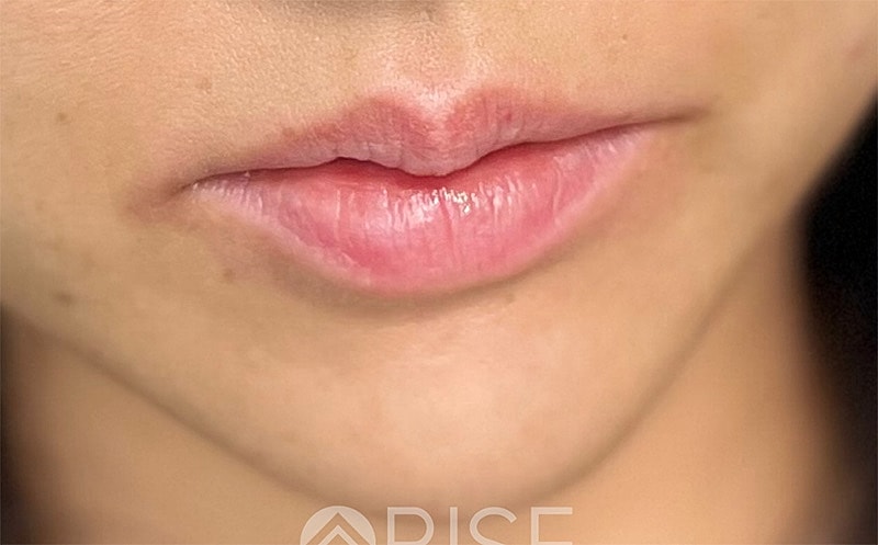 Lip Filler Before & After