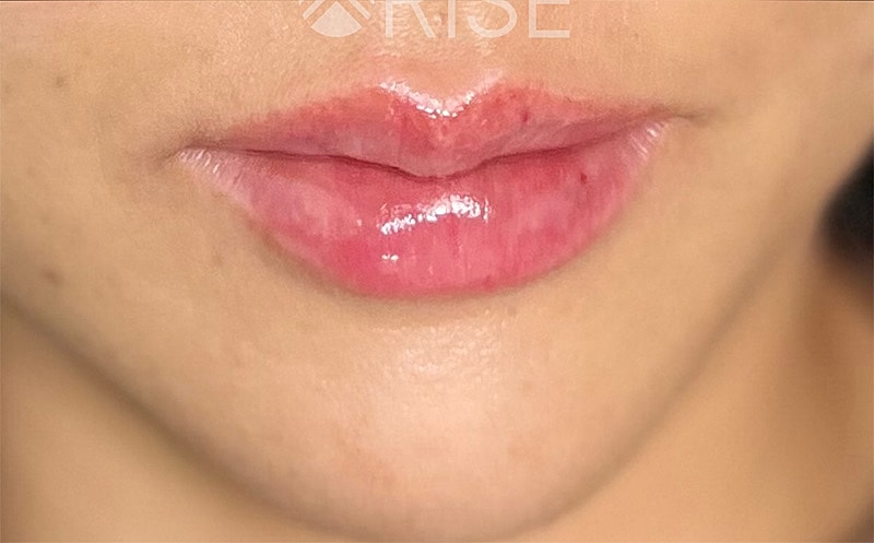 Lip Filler Before & After