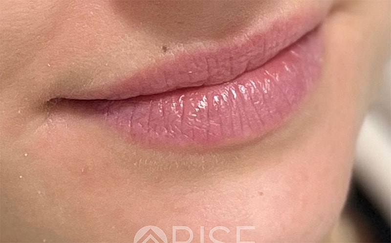 Lip Filler Before & After