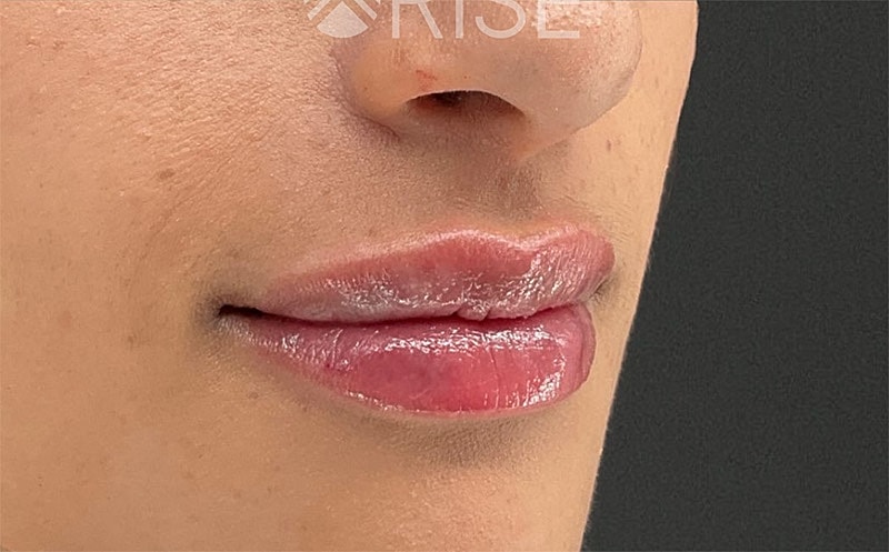 Lip Filler Before & After
