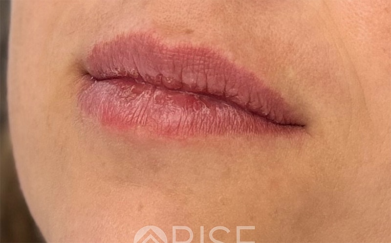 Lip Filler Before & After