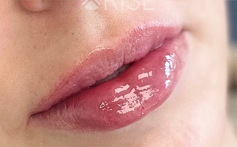 Lip Filler Before & After