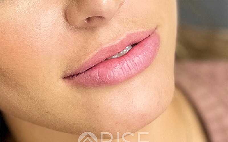 Lip Filler Before & After