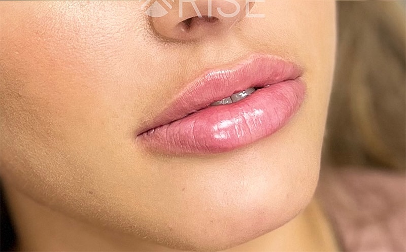 Lip Filler Before & After