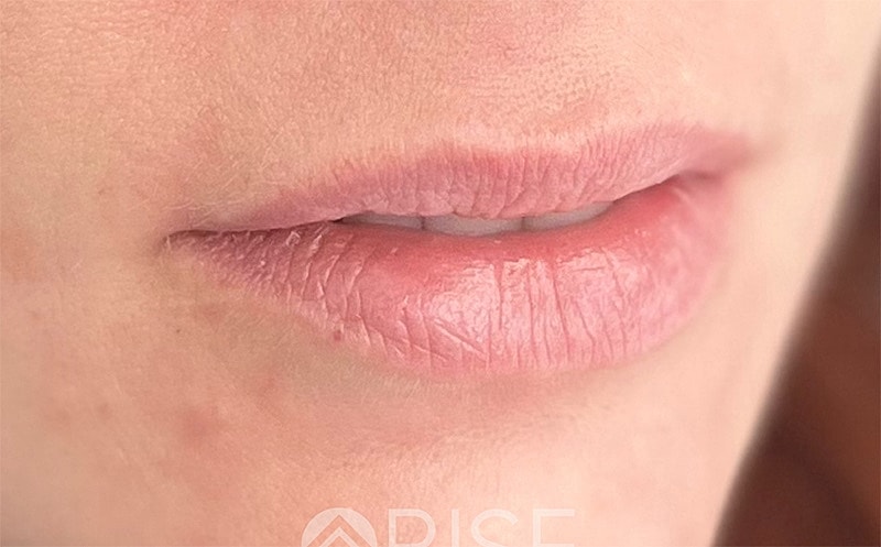 Lip Filler Before & After