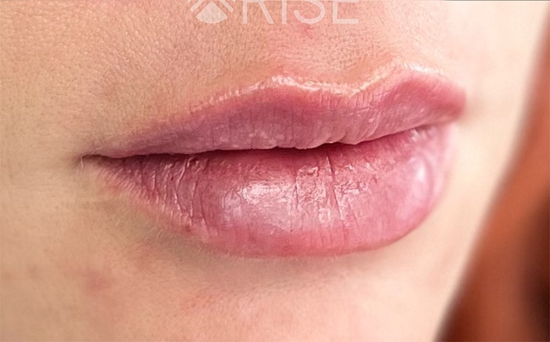 Lip Filler Before & After