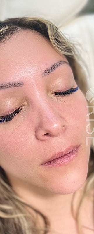 Lip Filler Before & After