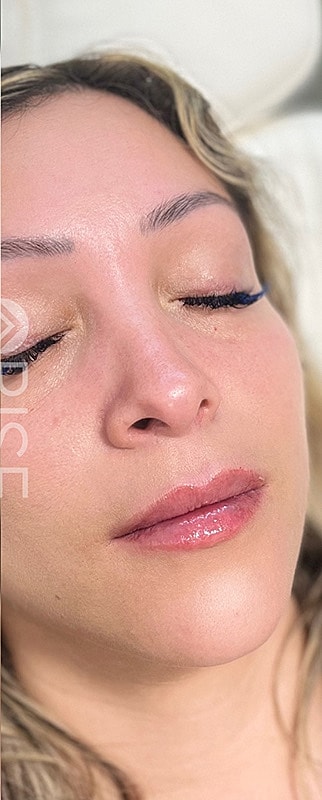 Lip Filler Before & After