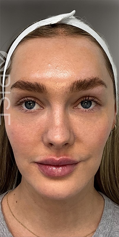 Lip Filler Before & After