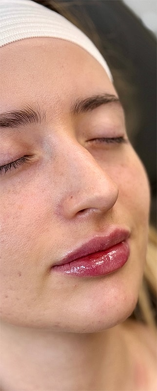 Lip Filler Before & After