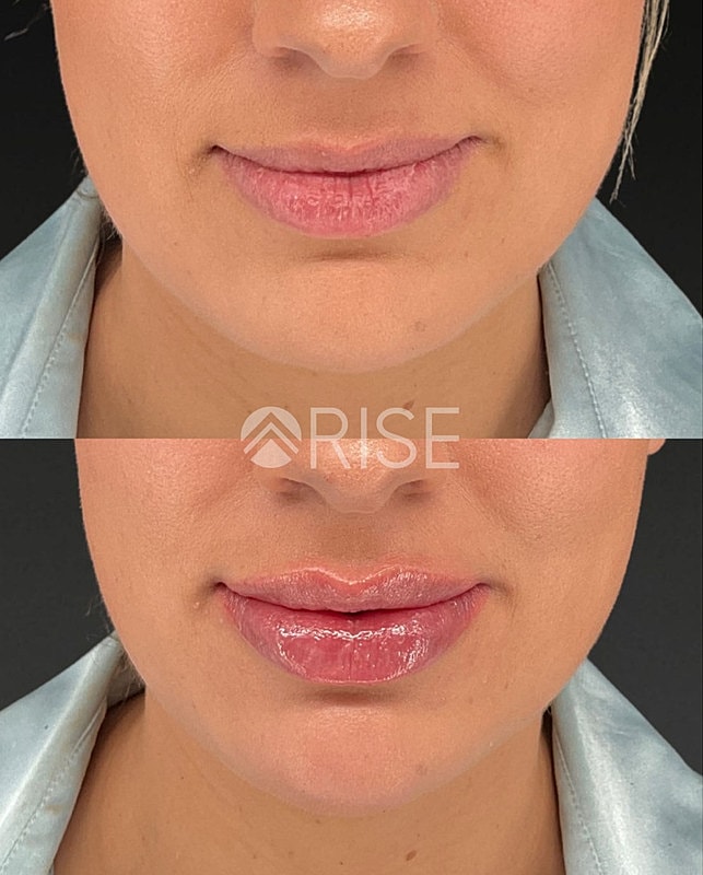 Lip enhancement before and after comparison image.