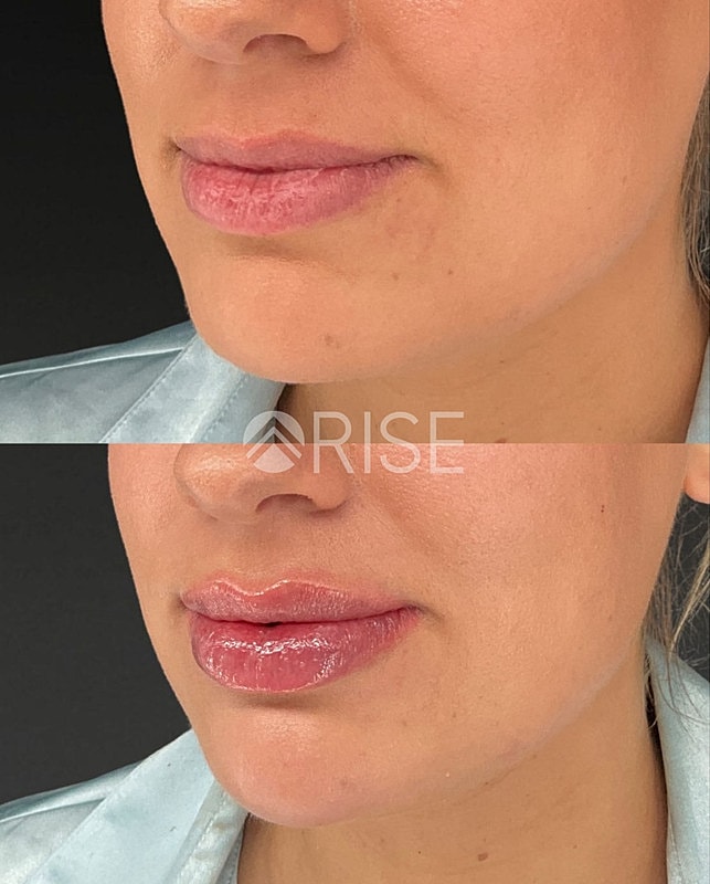 Before and after lip enhancement treatment.