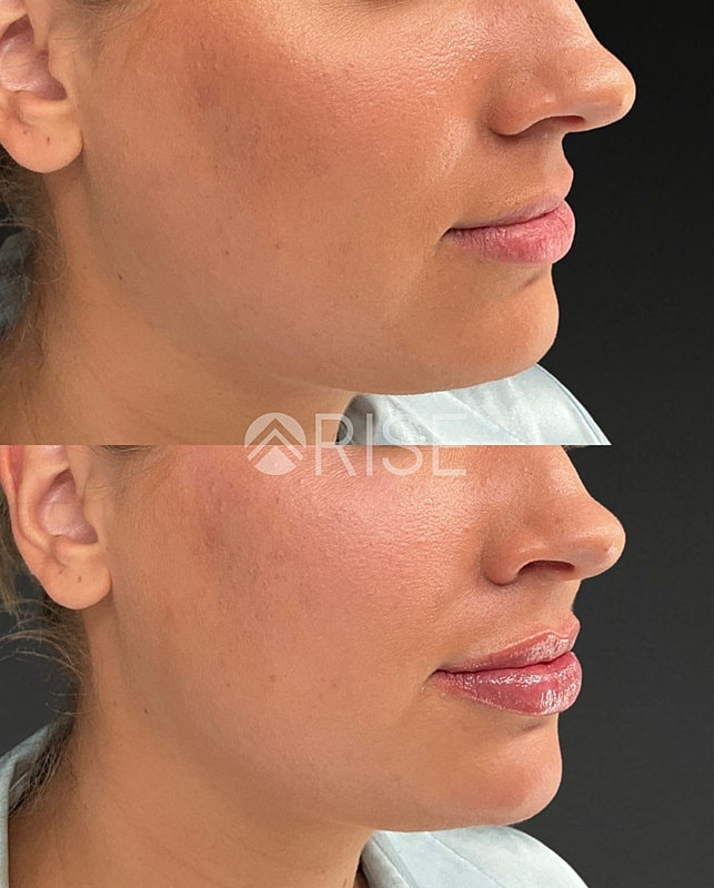 Before and after facial treatment comparison photograph.