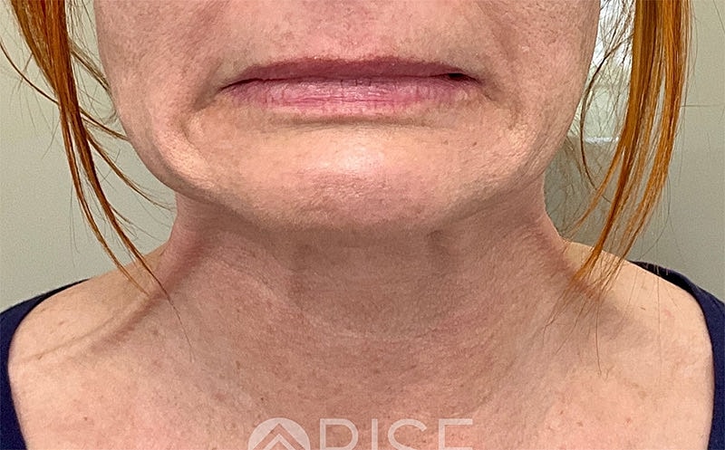 Botox Before & After