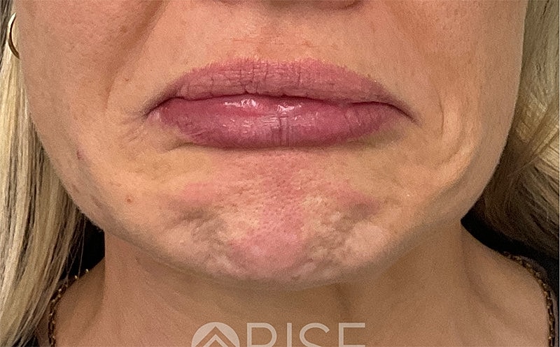 Botox Before & After