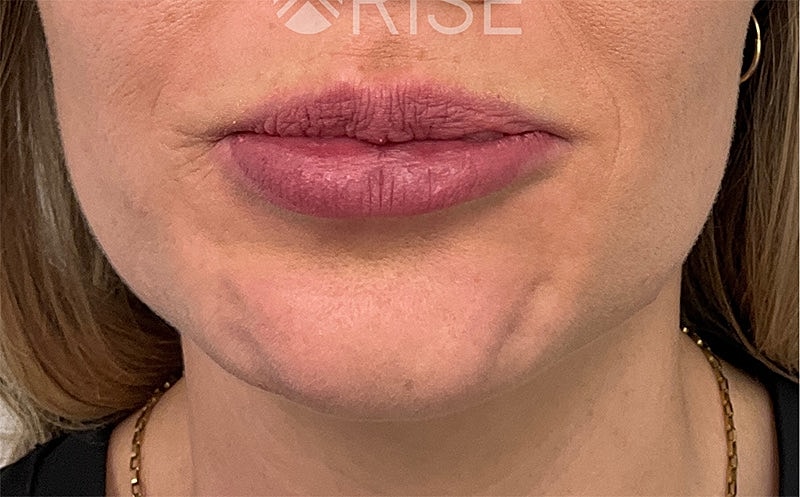 Botox Before & After