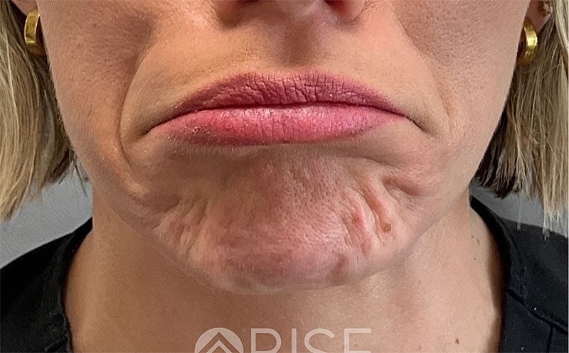 Botox Before & After