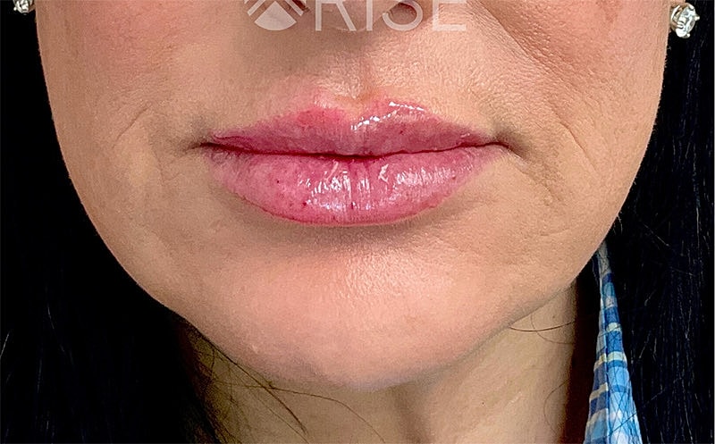 Botox Before & After