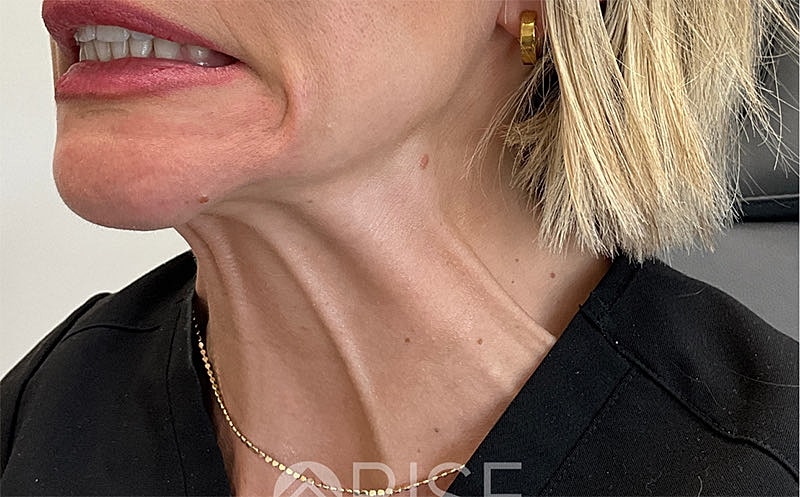 Botox Before & After