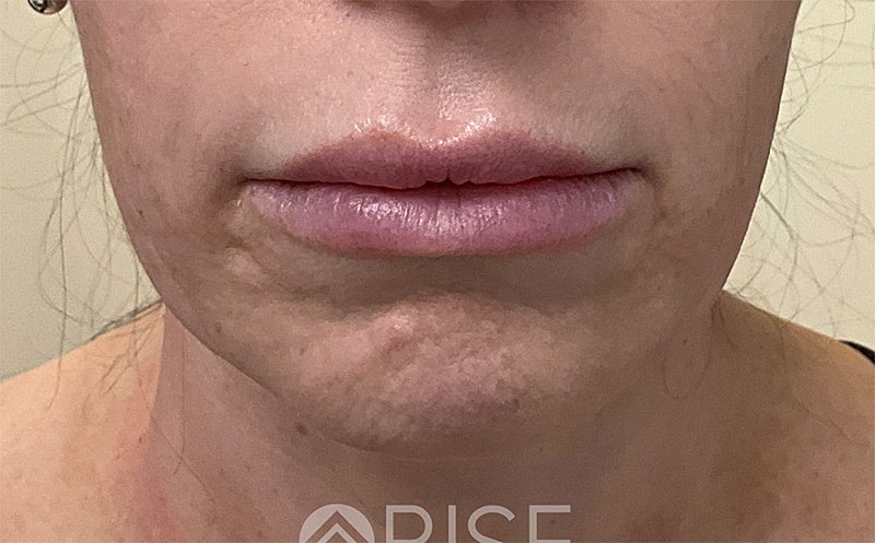 Botox Before & After