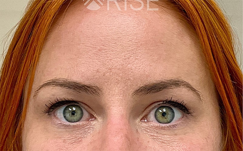 Botox Before & After