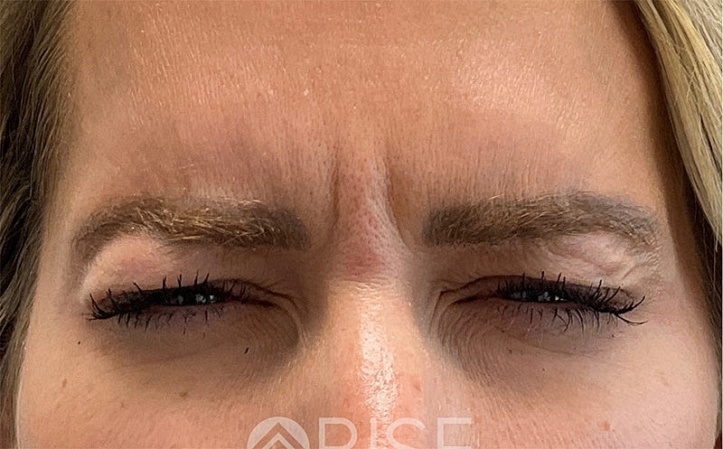Botox Before & After