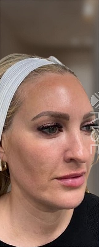 Botox Before & After