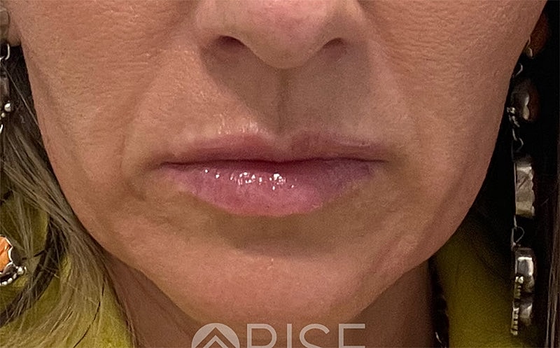 Sculptra Before & After