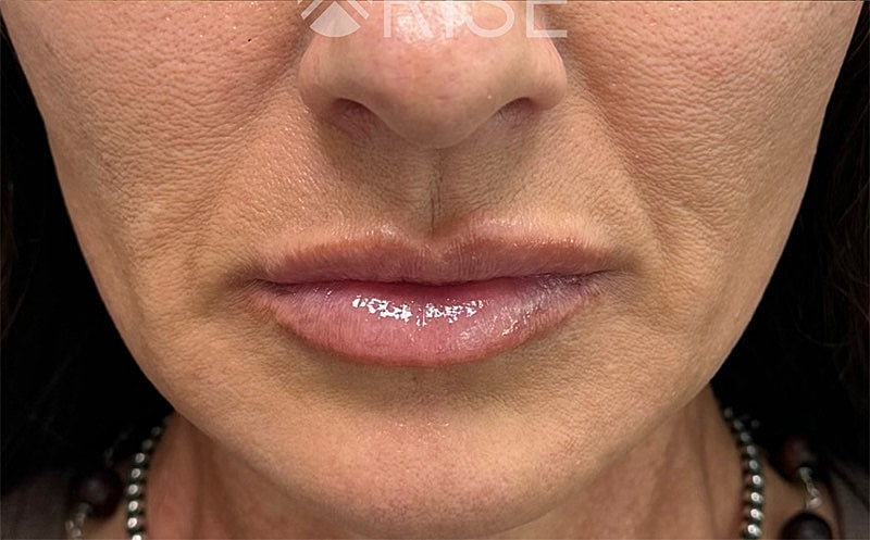 Sculptra Before & After