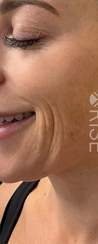 Sculptra Before & After