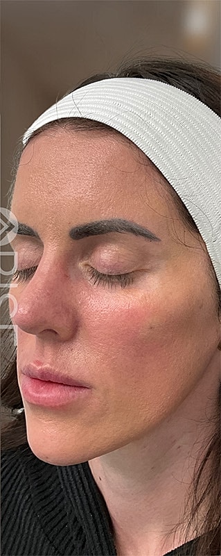 Sculptra Before & After