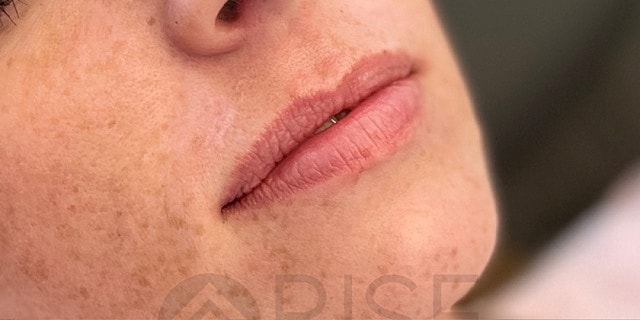 Dermal Fillers Before & After