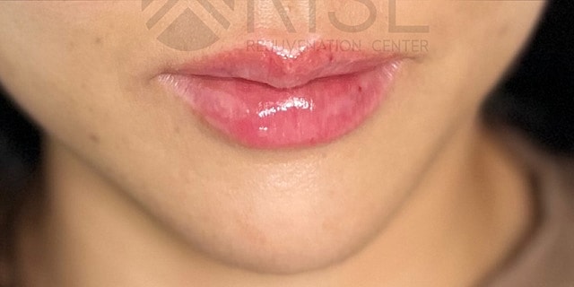 Dermal Fillers Before & After