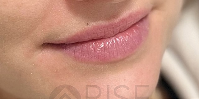 Dermal Fillers Before & After