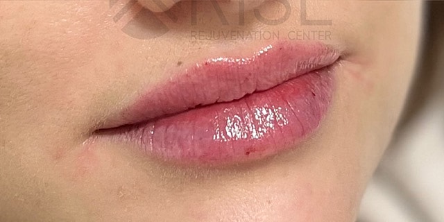 Dermal Fillers Before & After