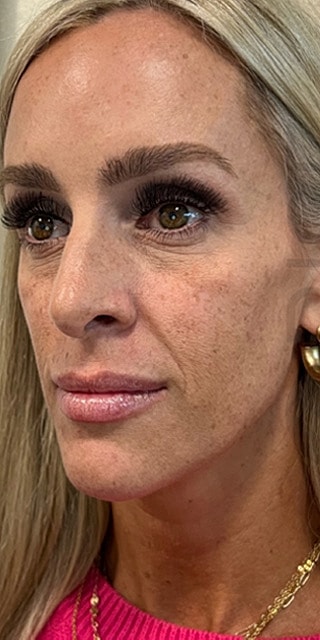 Dermal Fillers Before & After