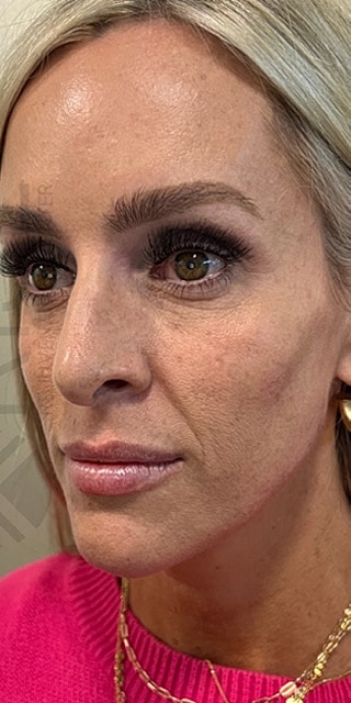 Dermal Fillers Before & After