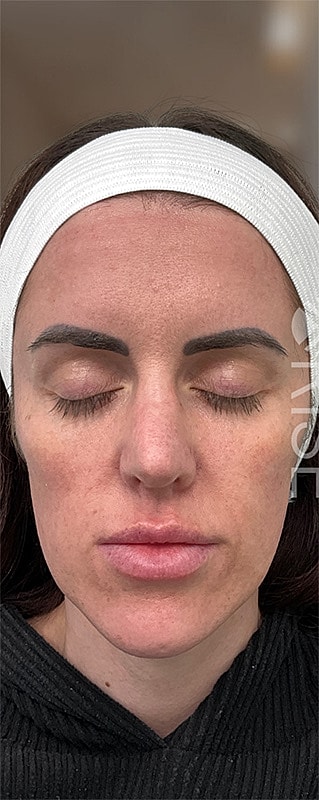 Dermal Fillers Before & After