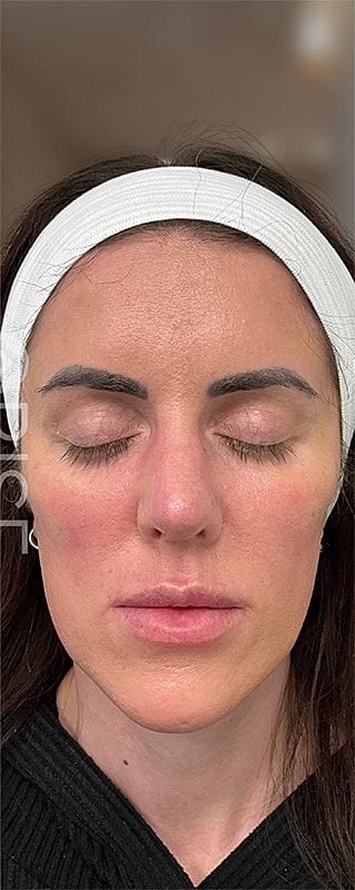 Dermal Fillers Before & After