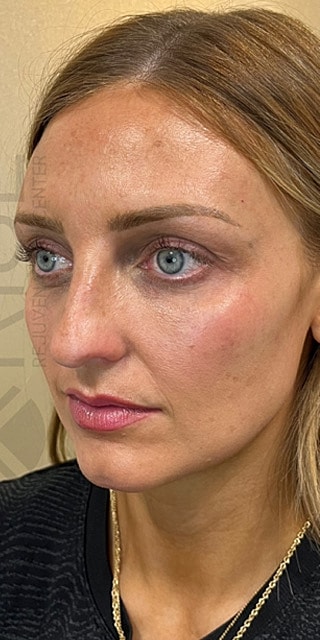 Bio Gel Before & After