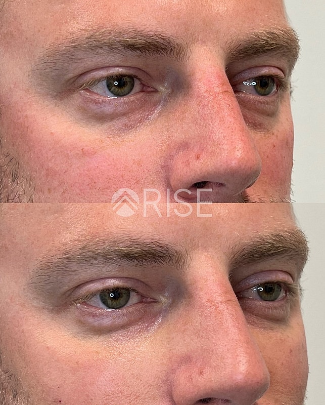 Before and after eye treatment comparison image.