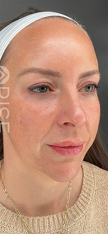 Under Eye Filler Before & After