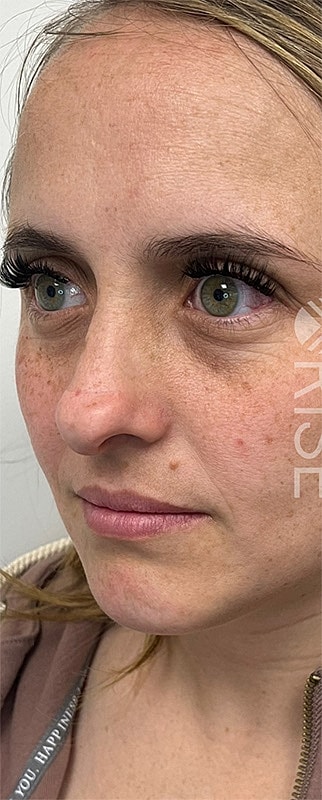 Under Eye Filler Before & After