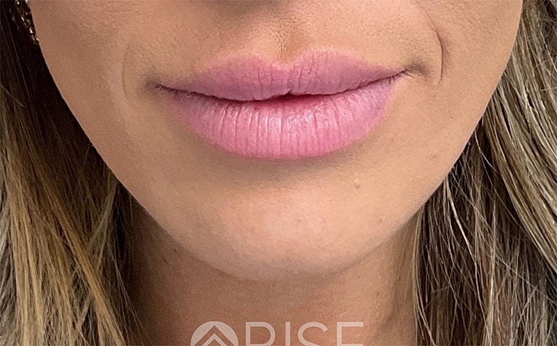 Filler Dissolving Before & After