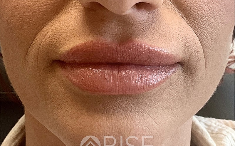 Filler Dissolving Before & After