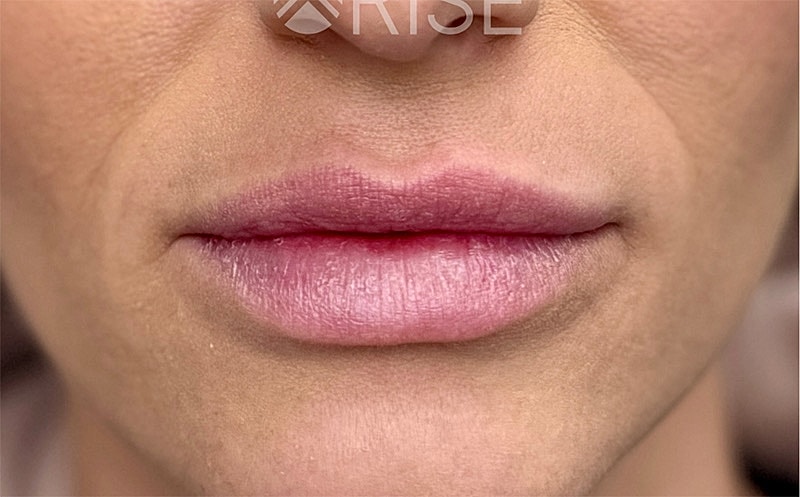 Filler Dissolving Before & After